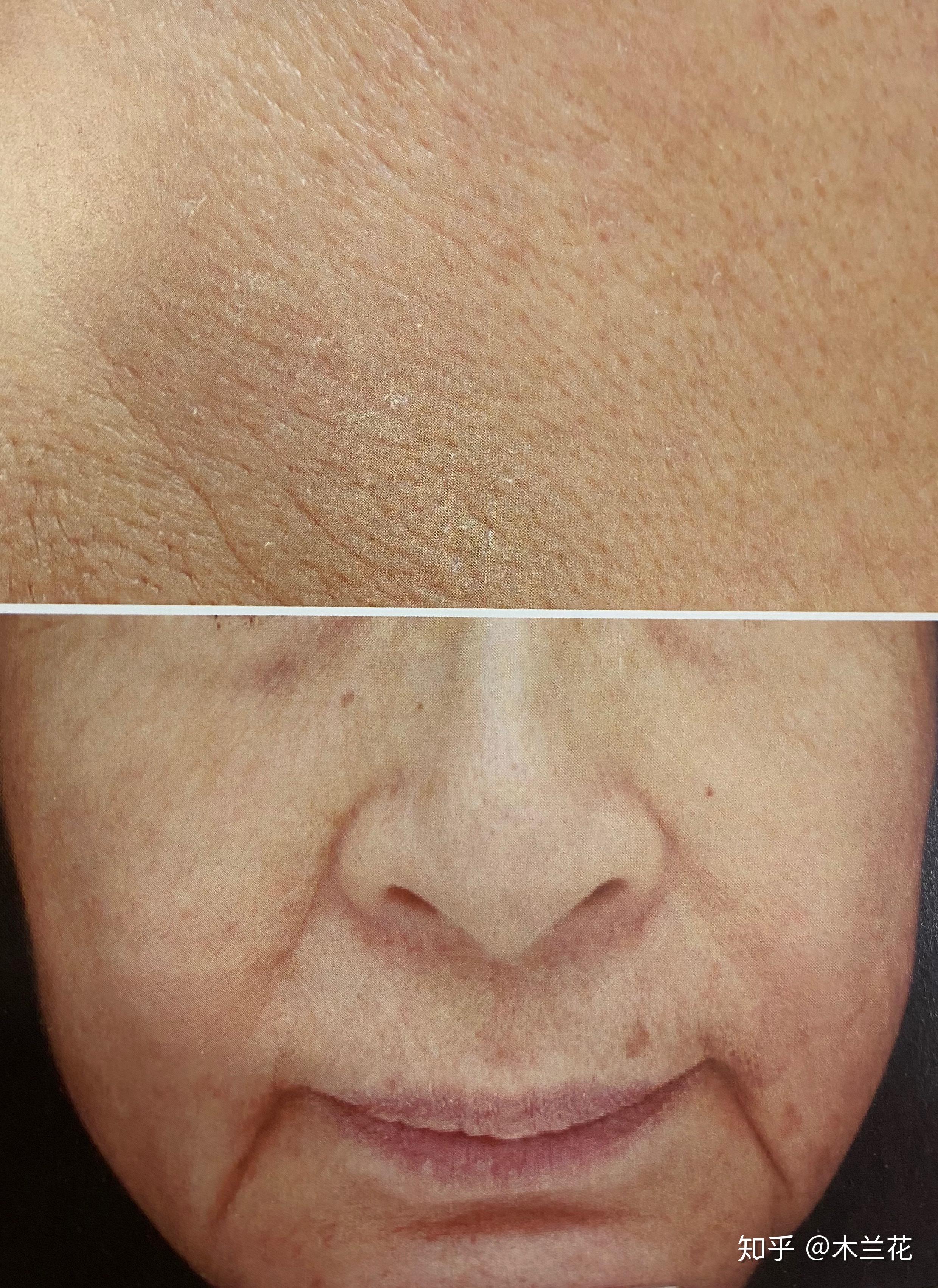 细纹爬上来怎么办悲伤那么大35岁0细纹秘籍