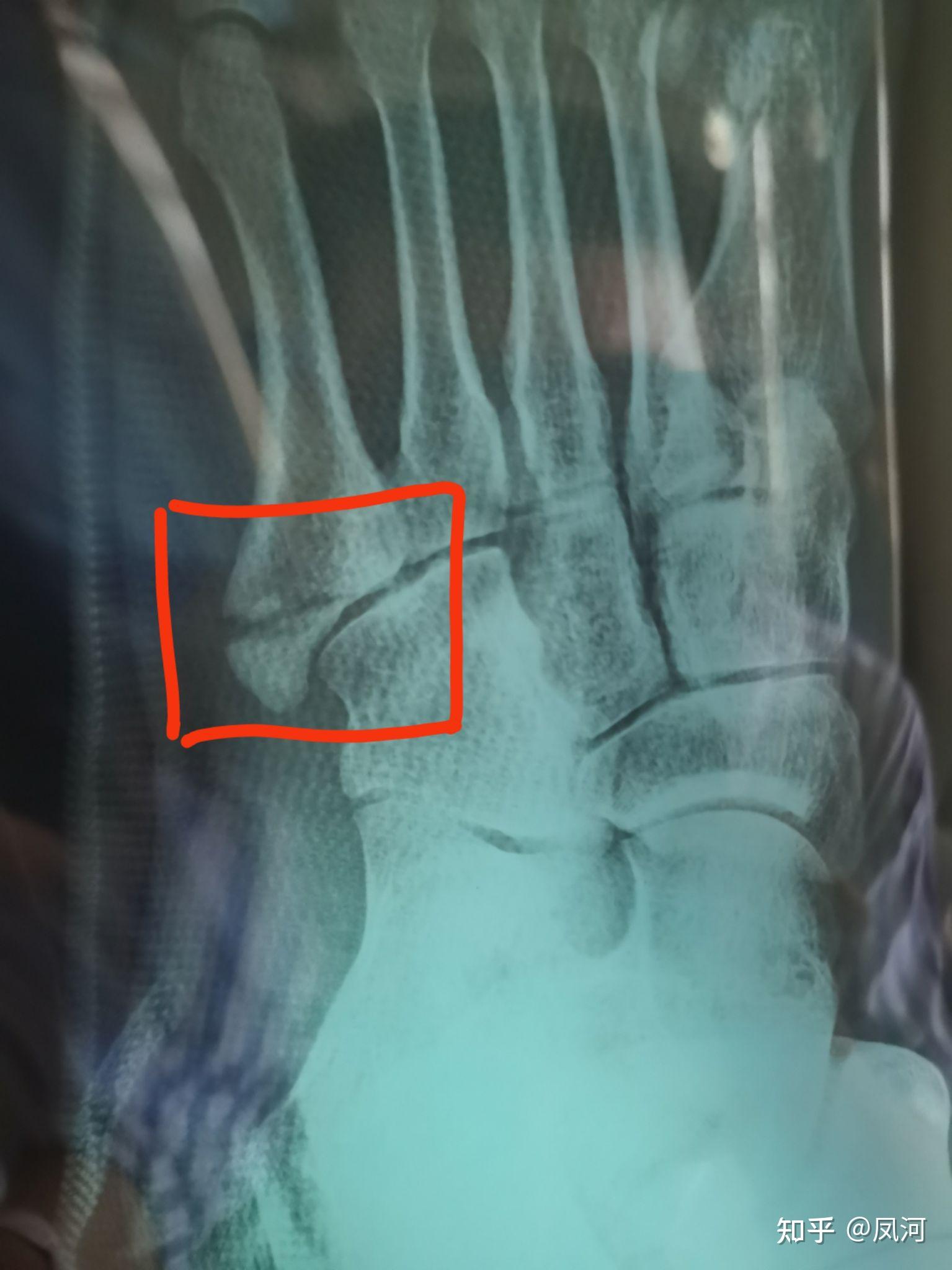 左第5跖骨骨折正常图图片