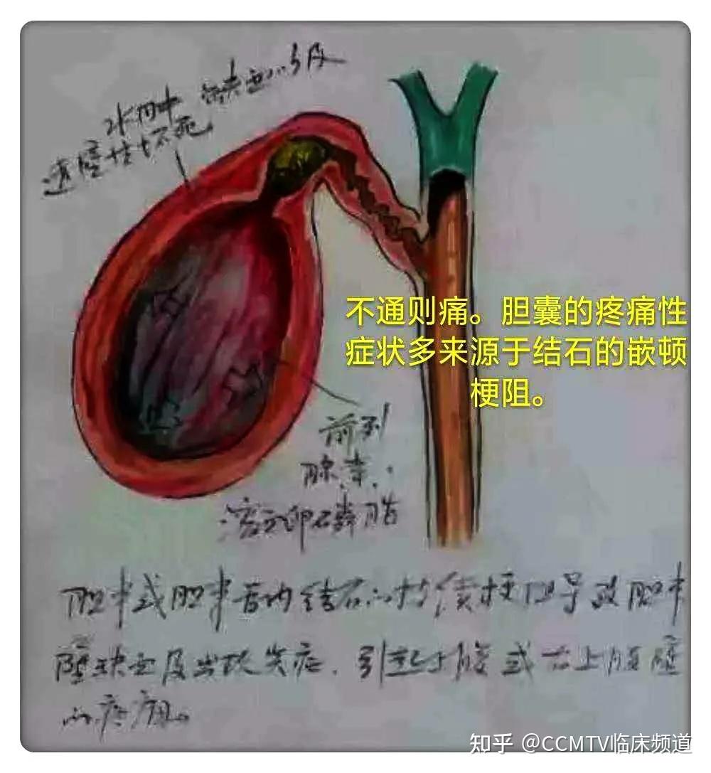 無症狀膽囊結石要不要做手術