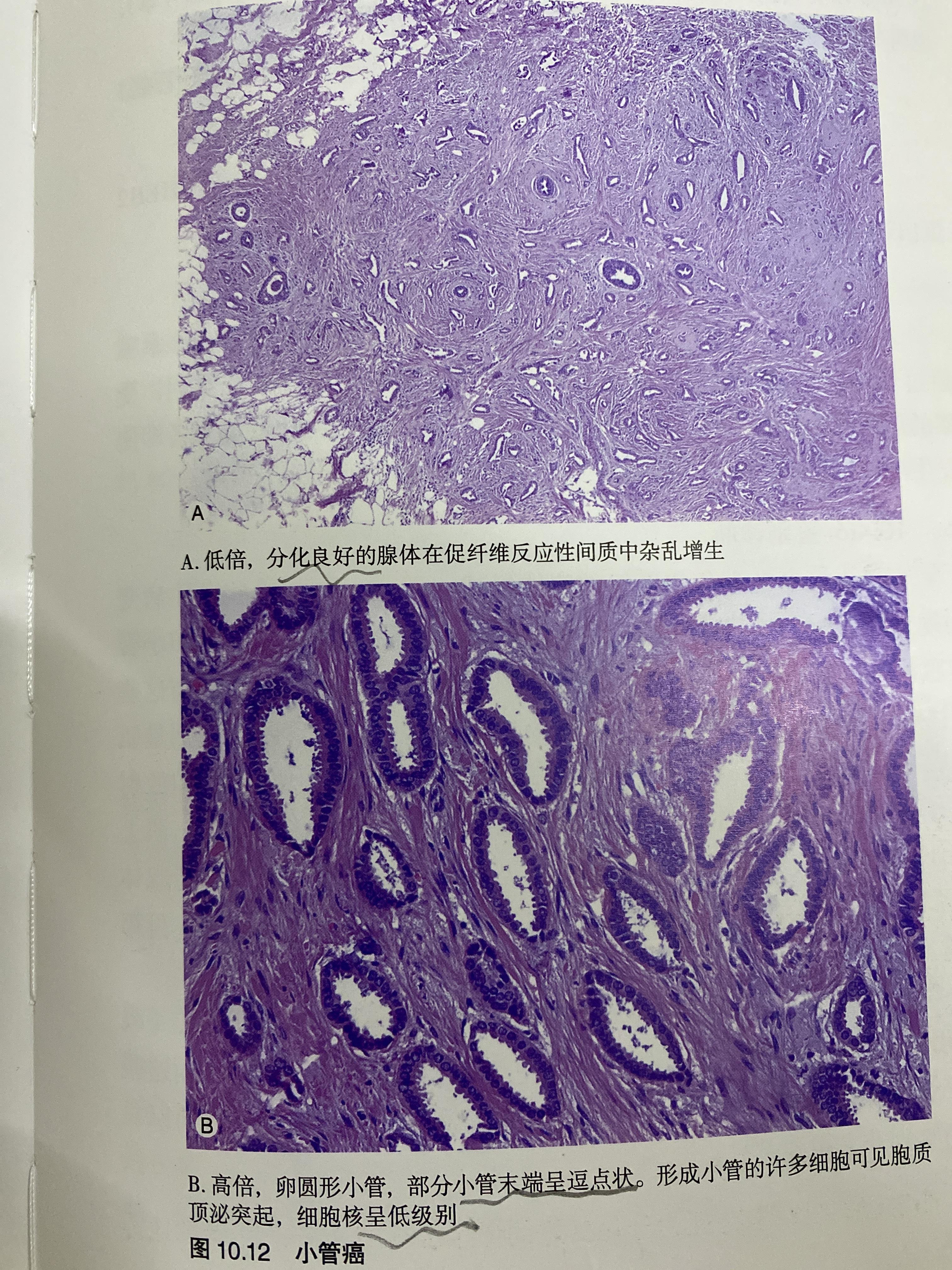 乳腺癌切片图片