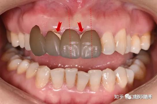 2021甄美明星秀口腔美学修复病例大赛示范案例前牙固定桥再修复一例