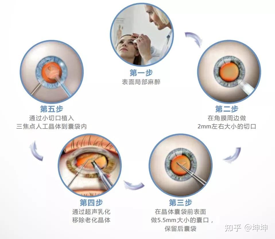 白内障治疗方法
