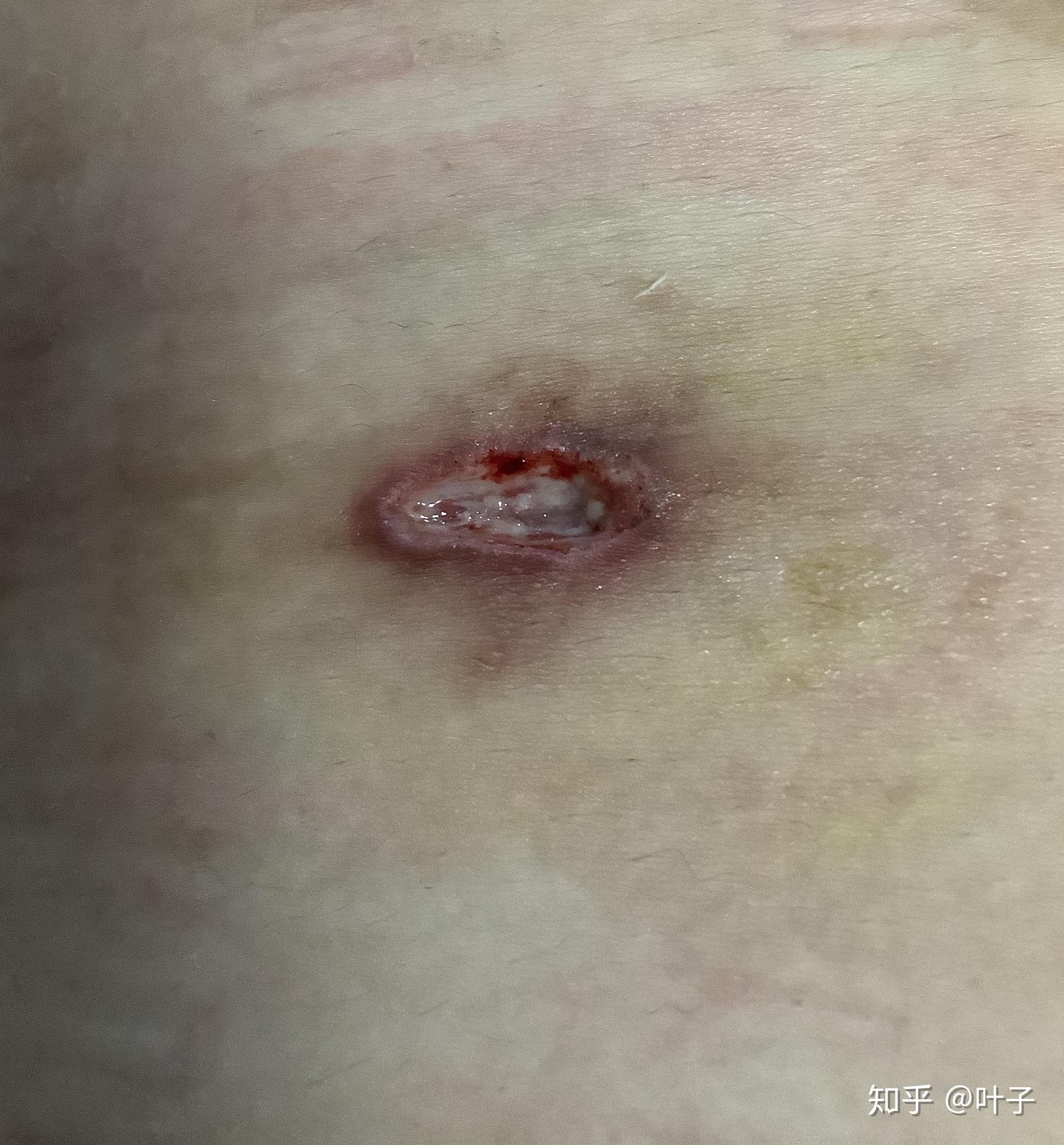 女人卵巢囊肿刀口图片图片