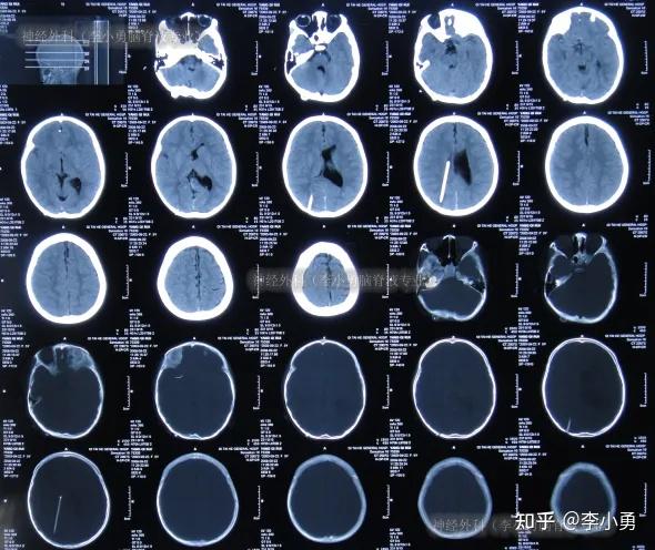 后枕小脑脊膜膨出术后仍脑积水,脑分流术后颅内感染性顽固头痛性昏迷