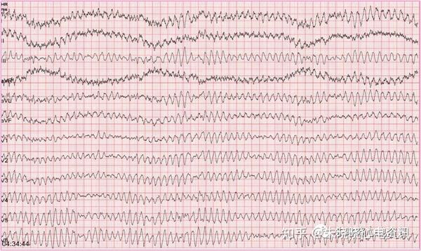 室撲與室速的區別:室速qrs波與t波分開,有等電位線. 3. 臨床舉例