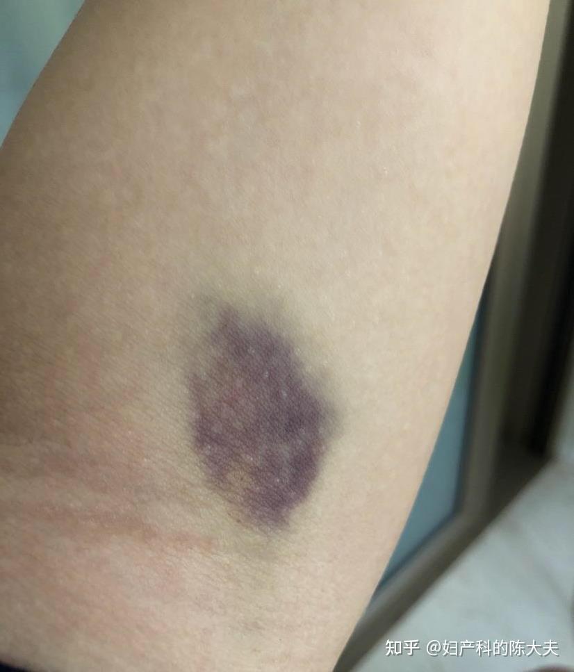 每次抽完血胳膊就青紫一大片?是我凝血功能不好吗? 