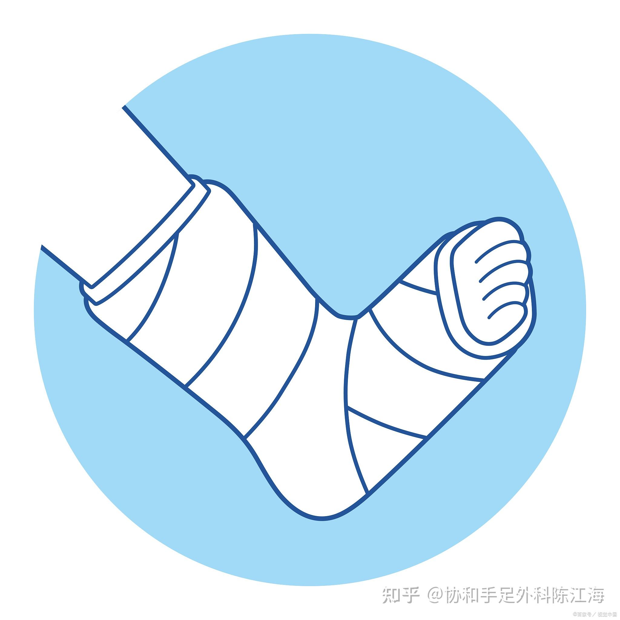 拇指位置,但是因为这种方法会造成脚部有创面,需要用石膏托外固定住