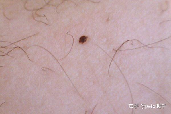 黑色素瘤指有恶性变化的色素斑痣,是由交界痣或混合痣性质的痣发展