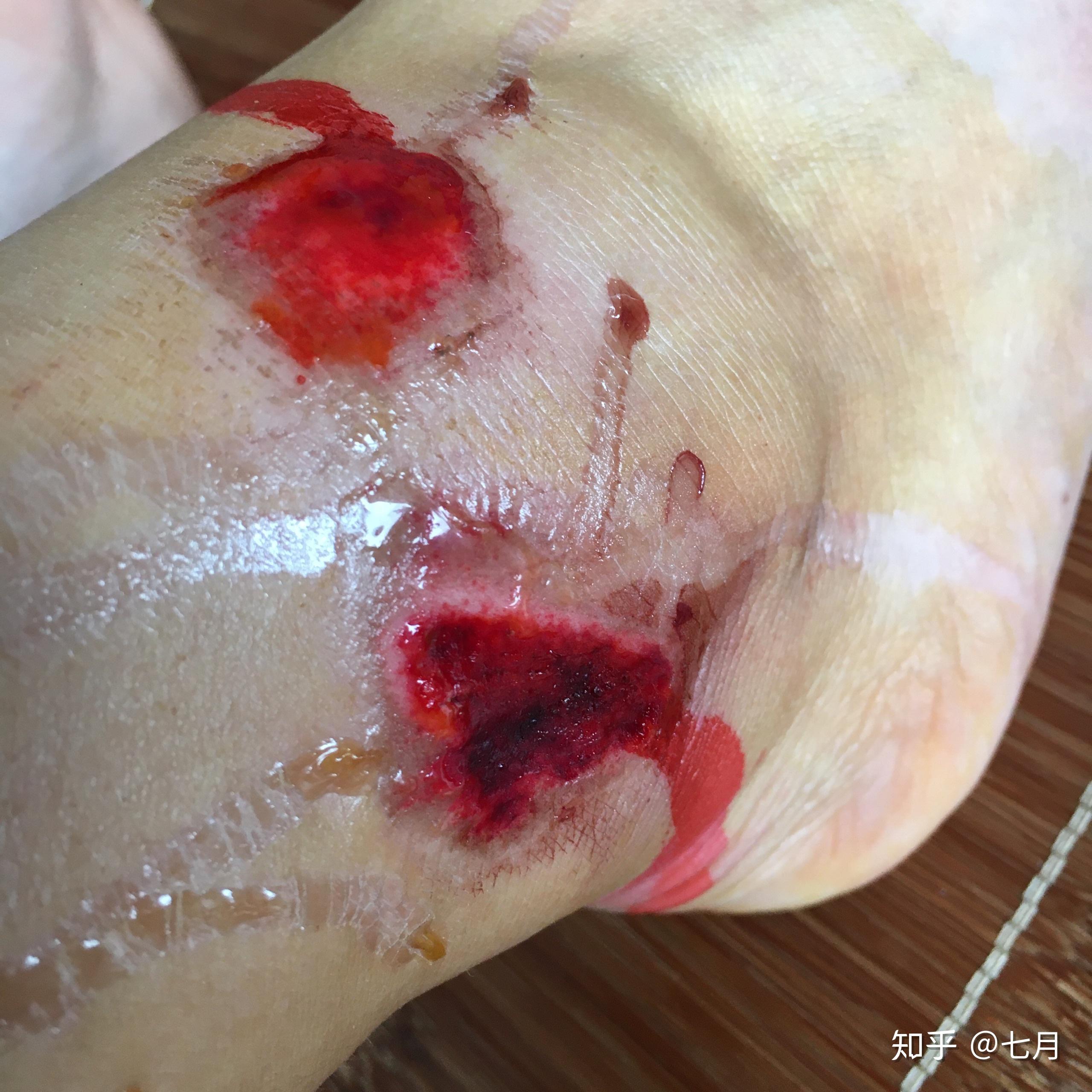 骑车侧翻膝盖摔伤破皮,怎么处理伤口,怎样才能不留疤? - 知乎