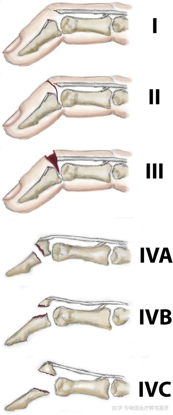 槌状指(Mallet Finger)——手指伸肌腱断裂 知乎