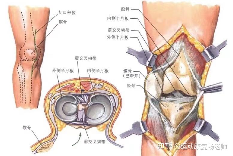 组成 膝关节由股骨胫骨髌骨等骨性结构组成