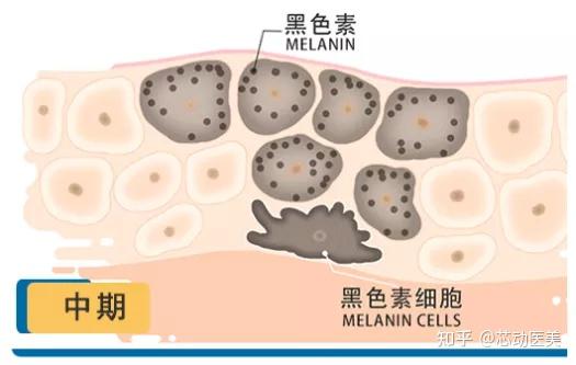 柠檬祛斑法有效吗 黄褐斑用什么祛除 知乎