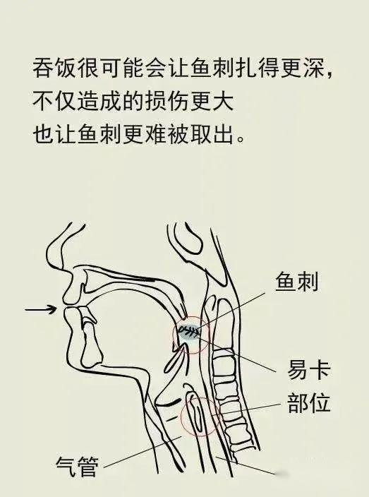 患者说:“鱼刺卡喉咙里了……” - 知乎