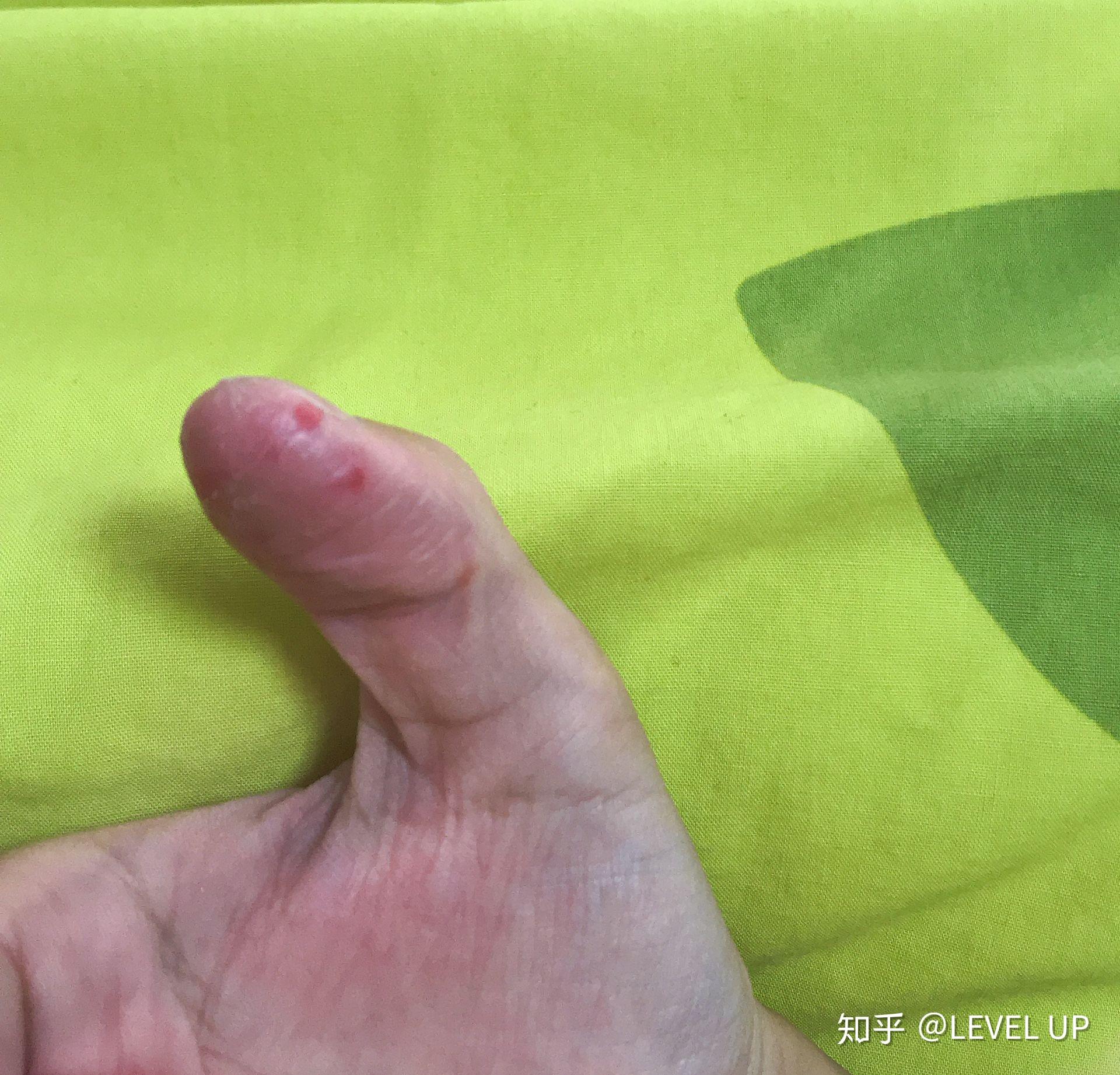 强迫性皮肤剥离症