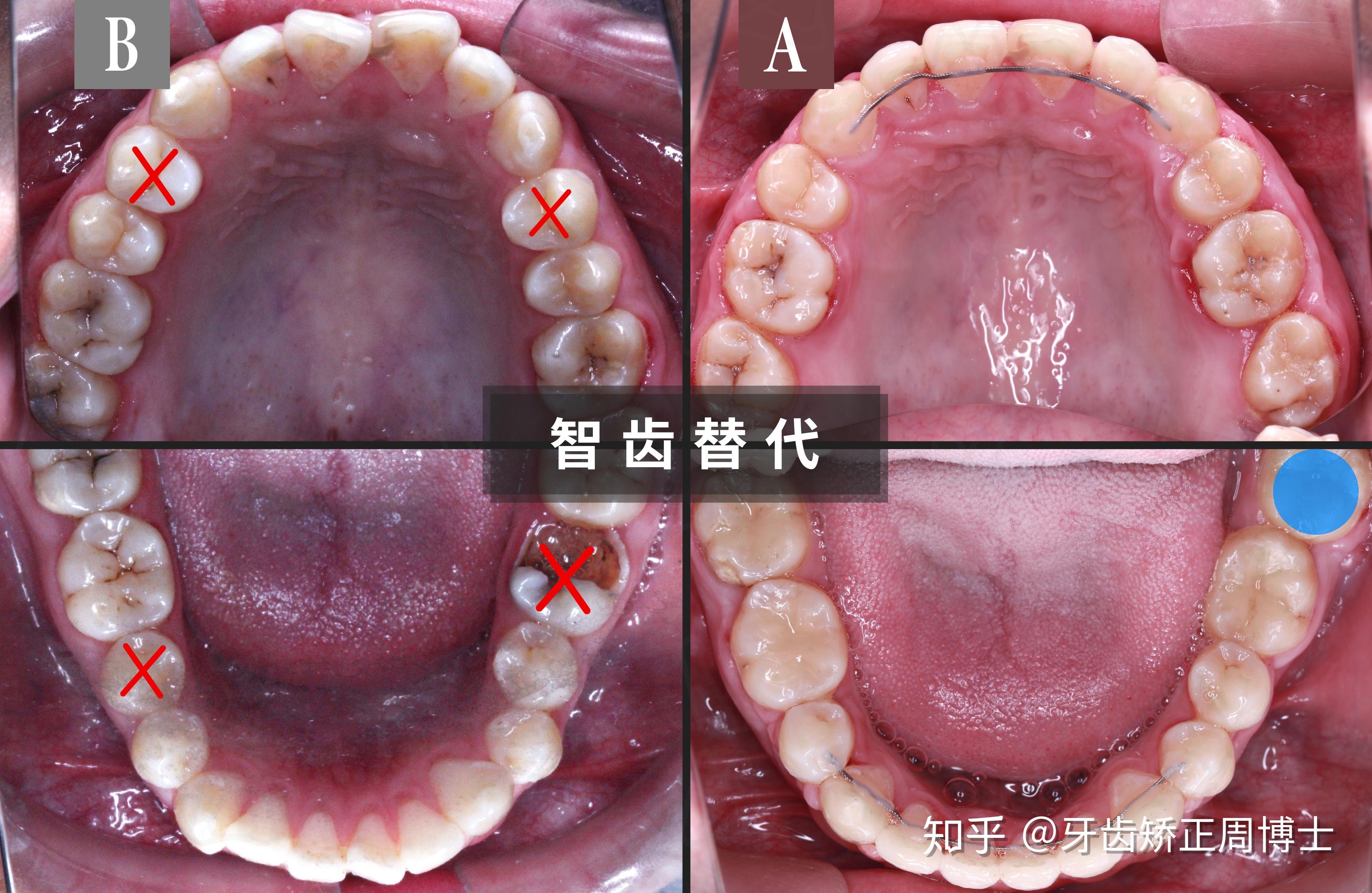 遵循優先拔除壞牙的原則,保留下完好的智齒,用7號牙向前移動替代6號牙