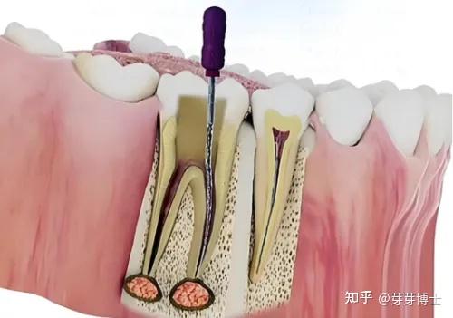 全网最详细的根管治疗全流程: 做根管治疗要去几次?根管治疗医保能报销吗?含2025补牙、根管治疗价格表 - 知乎