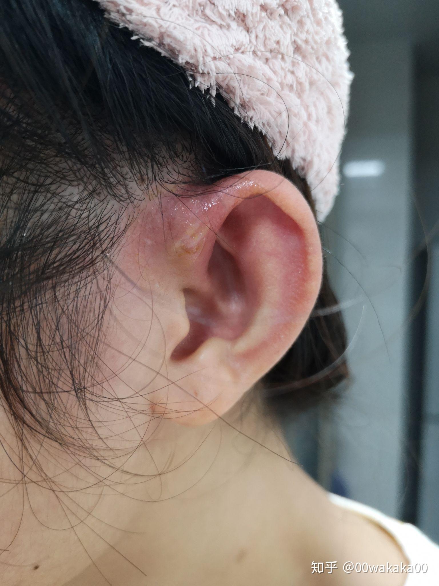 先天性耳前瘘管反复多次手术，为什么还复发 - 好大夫在线