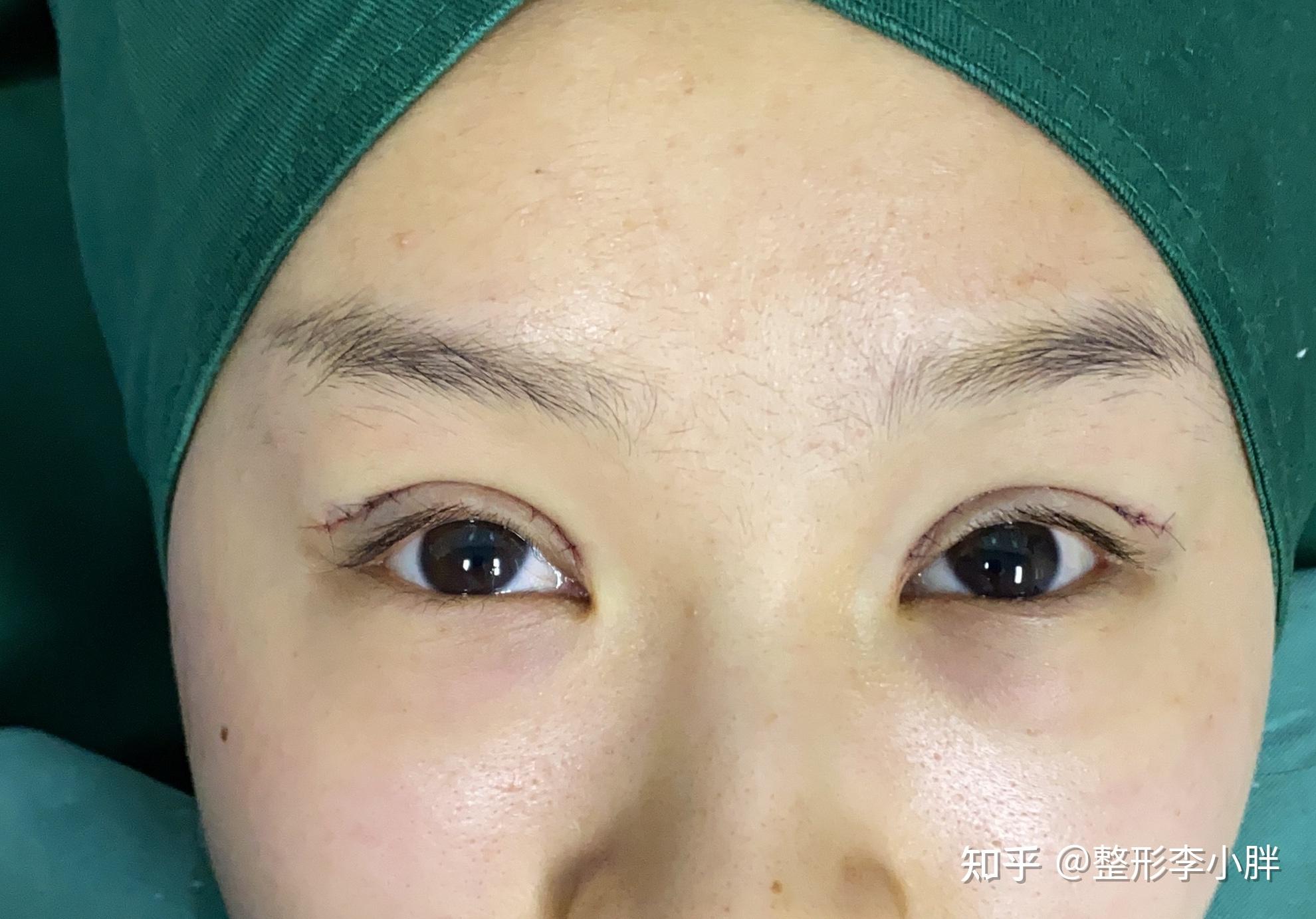 主刀手稿肿眼泡做双眼皮手术后竟然这么好看纯干货