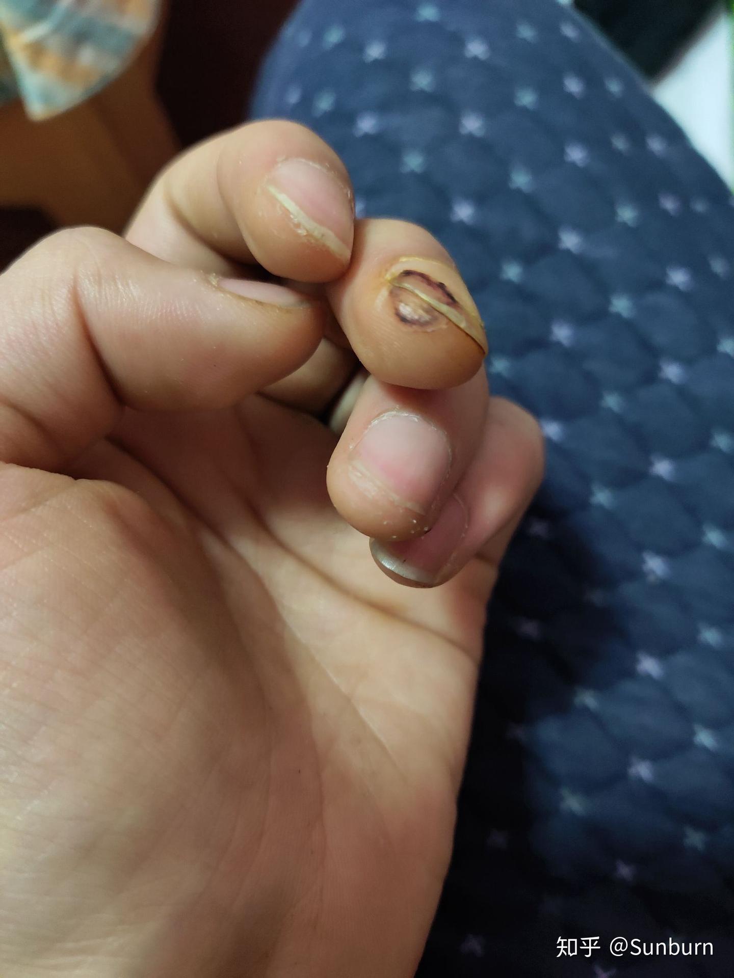 手指切伤恢复记录贴 - 知乎