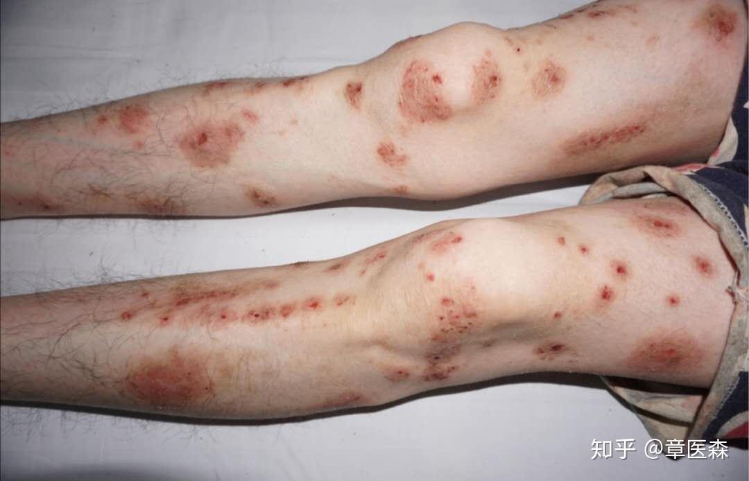 如何快速自我诊断湿疹以及初步处理