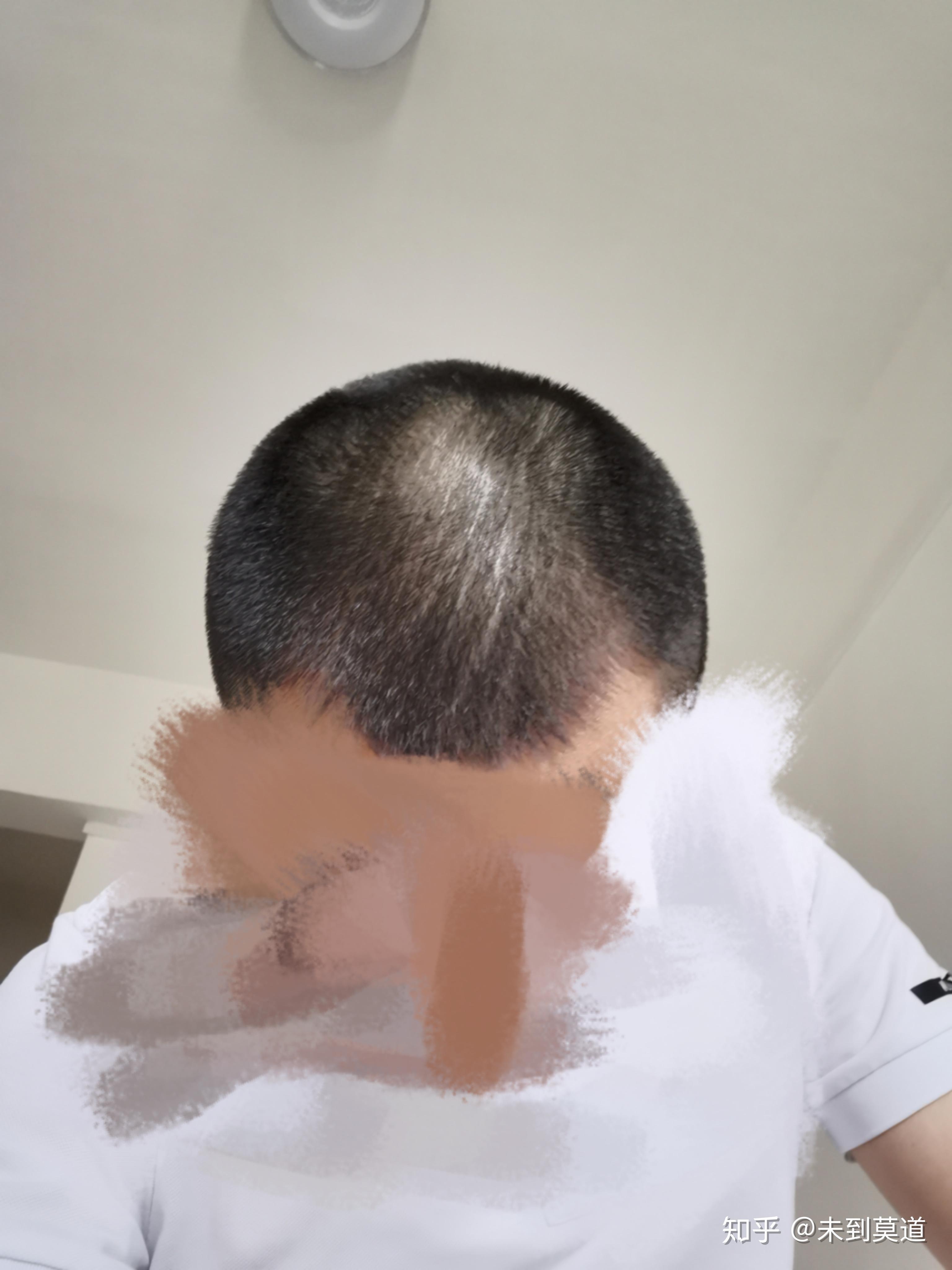 雄性激素脱发m型脱治疗记录贴