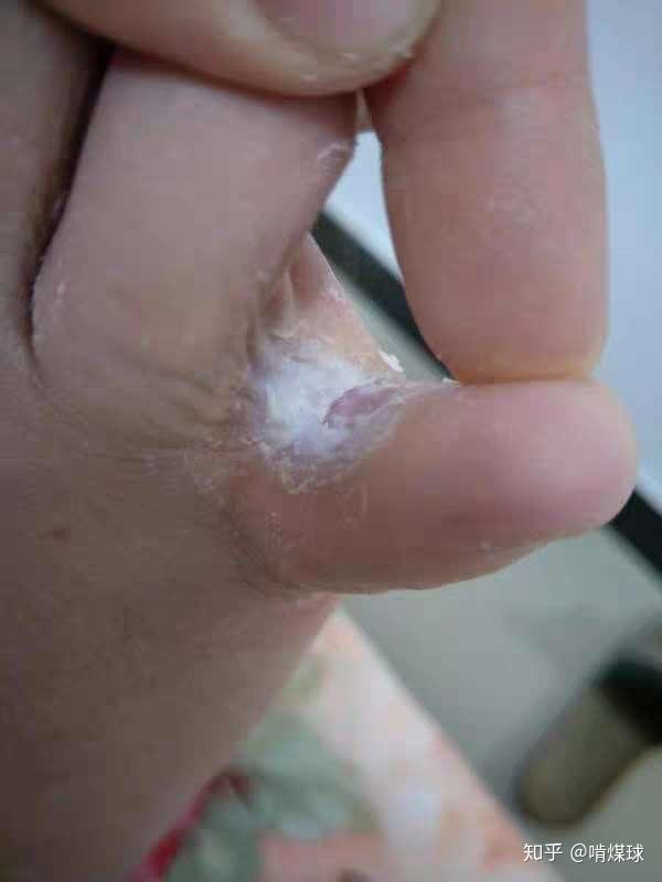 烂脚丫的脚气病如何快速治好和不再复发