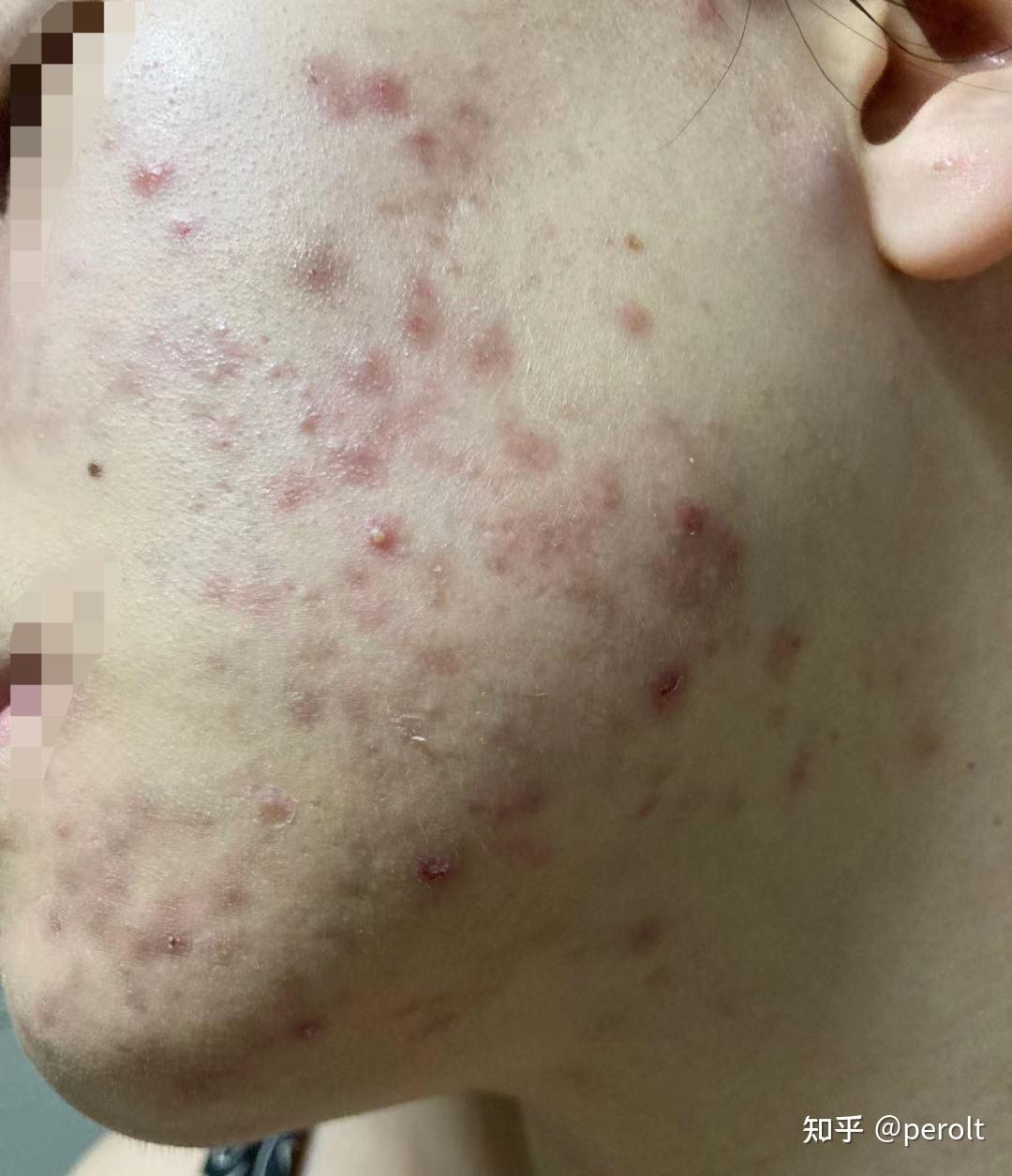 烂脸闭口粉刺治愈记录