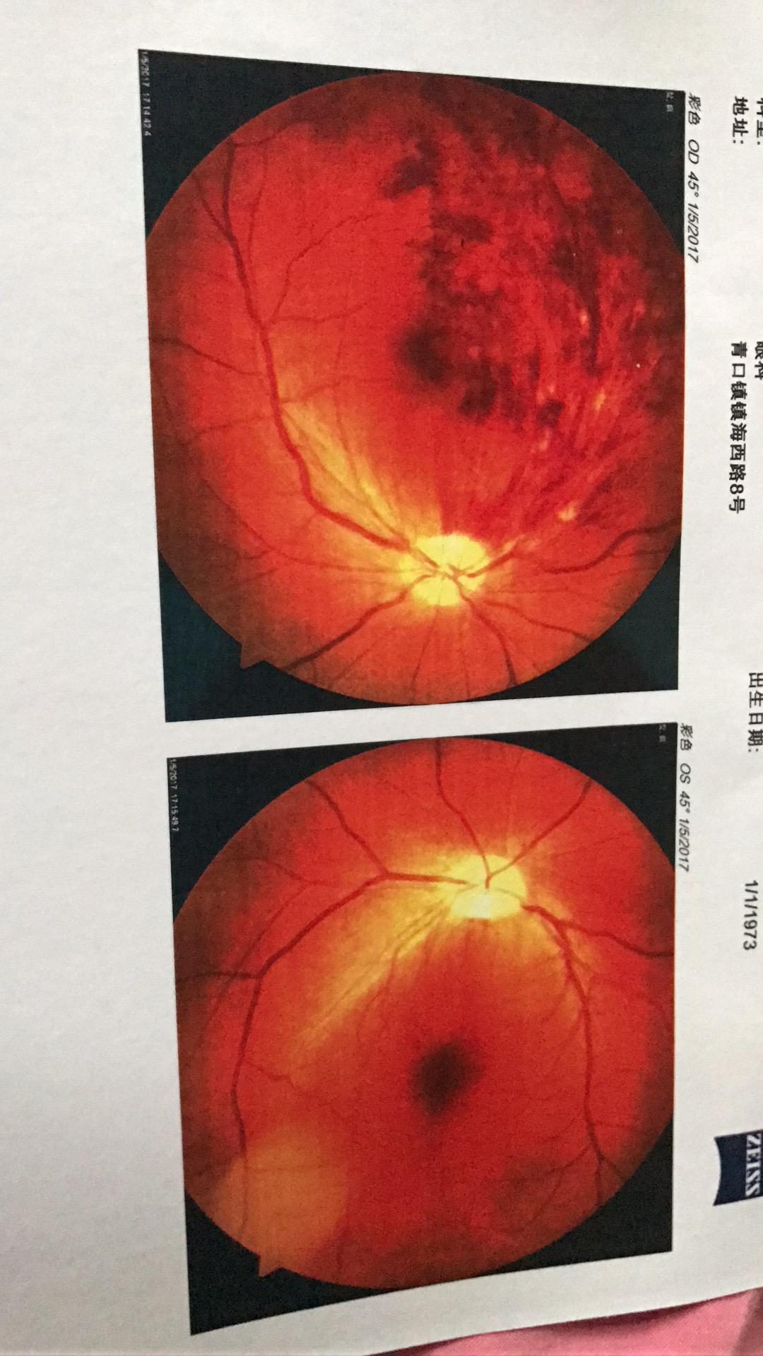 高血压带眼睛充血到底有多严重需要住院观察吗