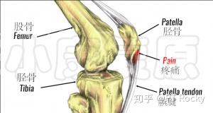跳跃者膝盖疼痛最常见原因是髌腱炎 知乎