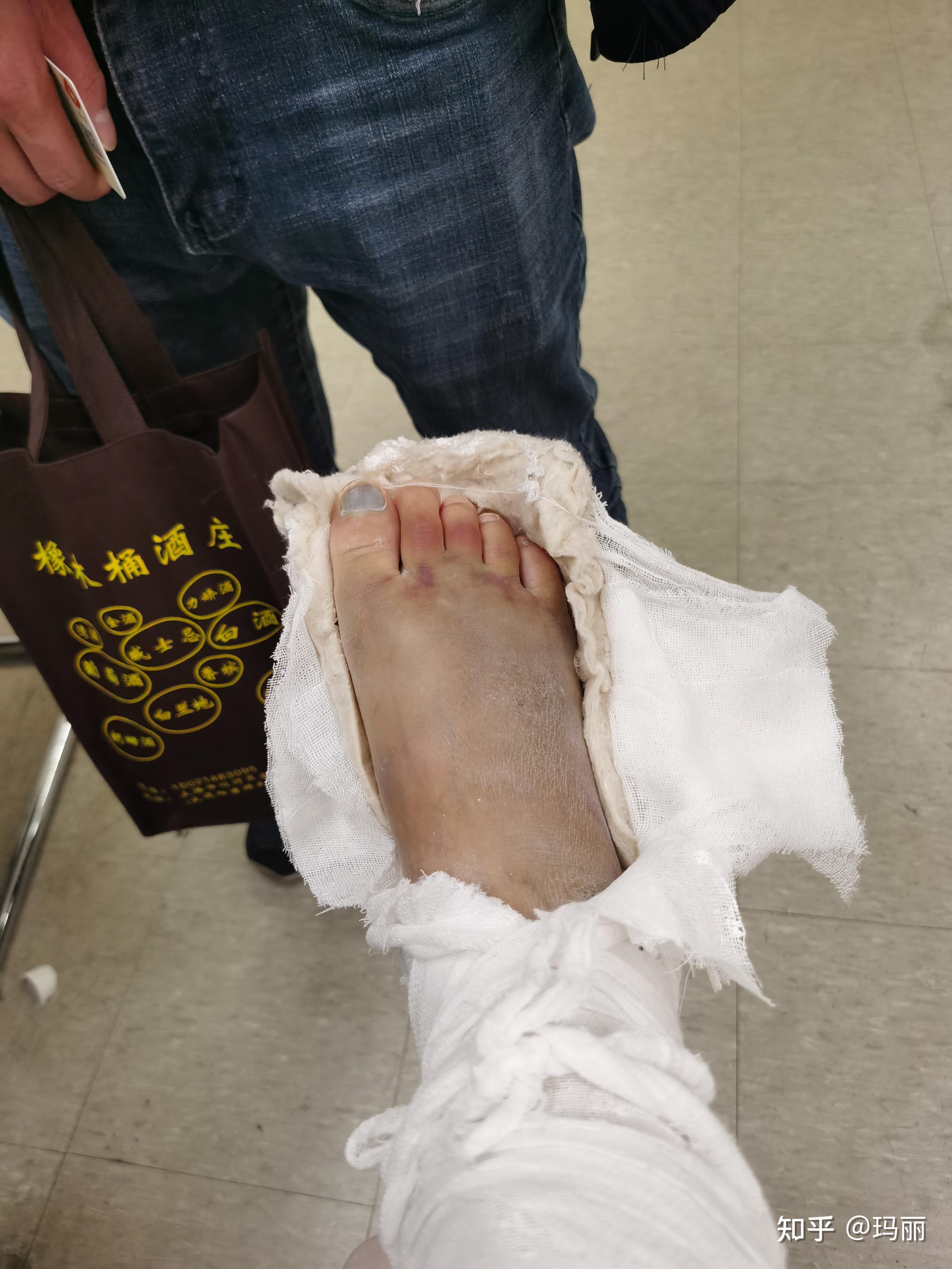 脚背骨折 - 知乎