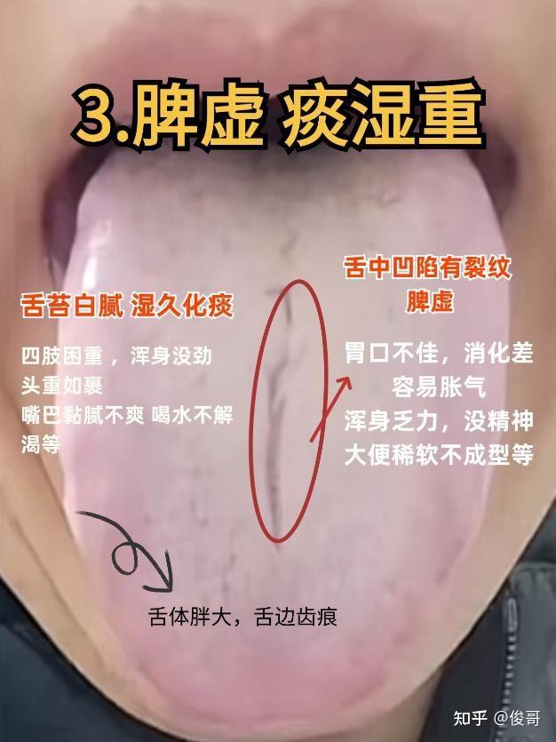 脾虚的4种常见舌象，看看你属于哪一类？ 1.肝郁脾虚——舌边鼓胀，舌中凹陷 2.脾虚湿气重——舌体胖大，边有齿痕，舌中凹陷有裂纹 3.脾虚痰湿 ...