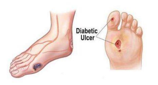 糖尿病足有哪些表现?致病原因是什么?该如何预防和治疗呢?