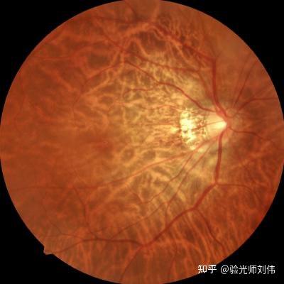豹纹状眼底的发生原因: - 知乎