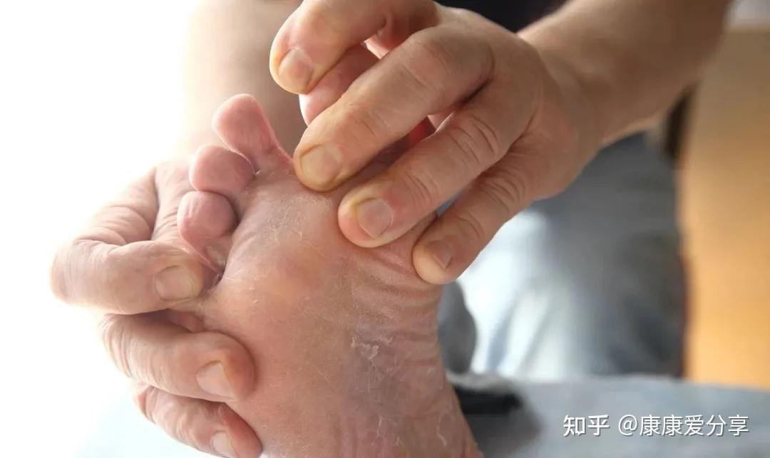 一文教区分脚气病与足癣内含治疗药方管用