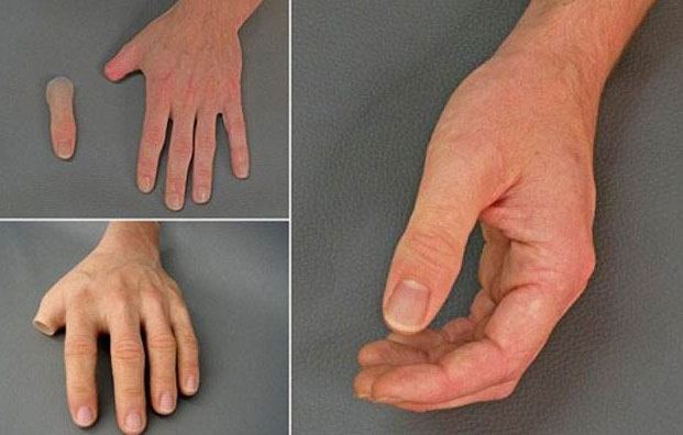 上肢假肢(手假肢)日常康复训练方法