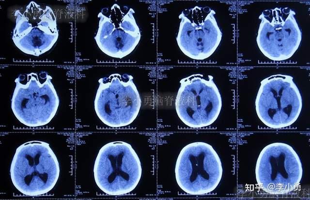 腦出血後腦積水4月內3家醫院治後病情仍反覆頭頸肩痛不能眨眼睡時尿