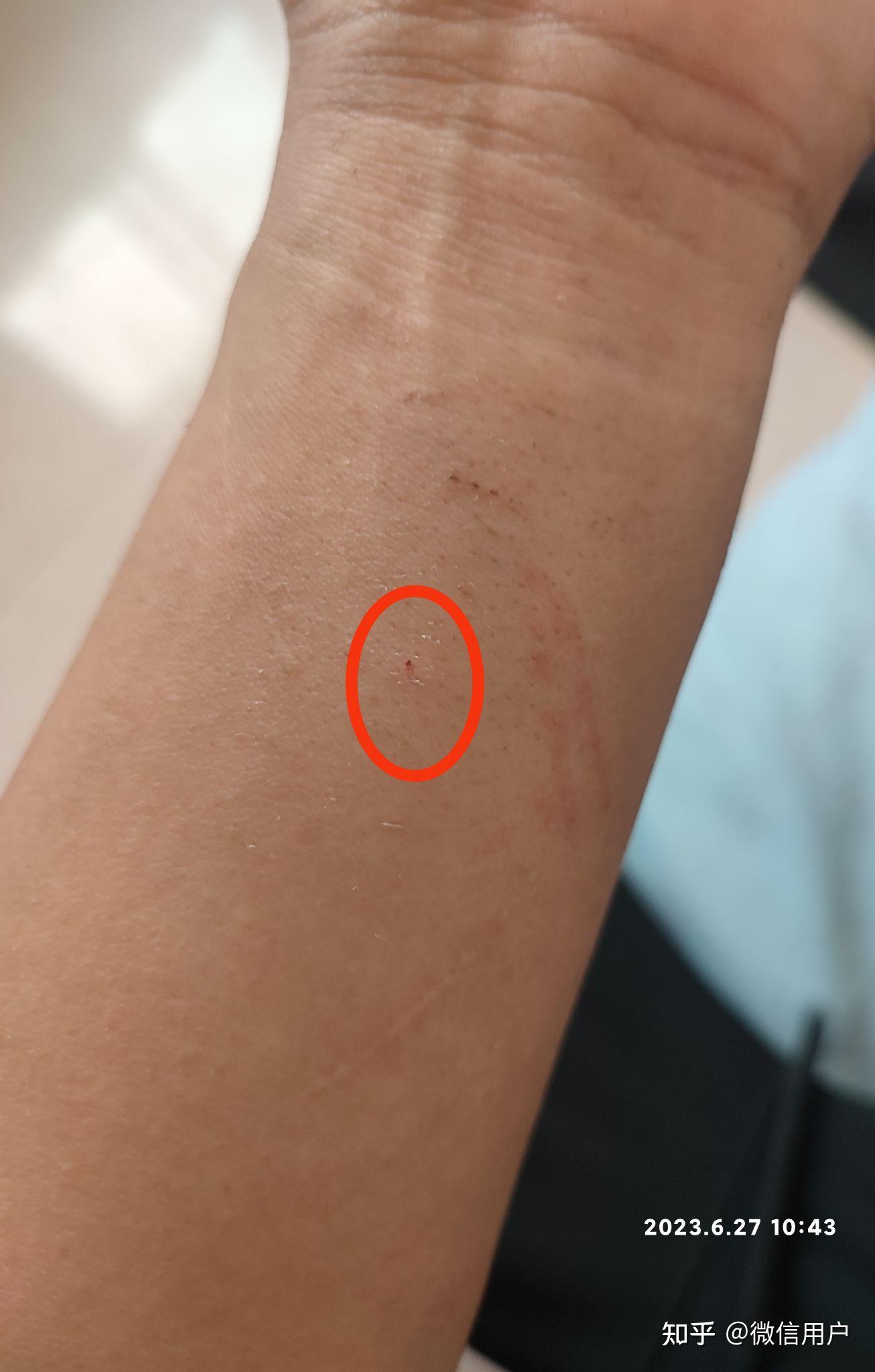 为什么破伤风抗毒素皮试阳性很多,因为有人不要脸啊