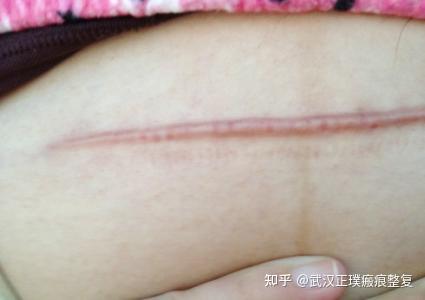 瘢痕科普小常识什么是增生性疤痕