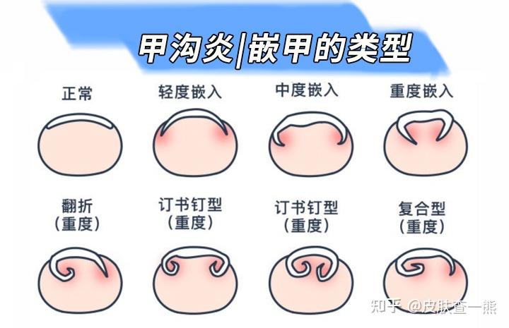 甲分离和灰指甲的区别图片