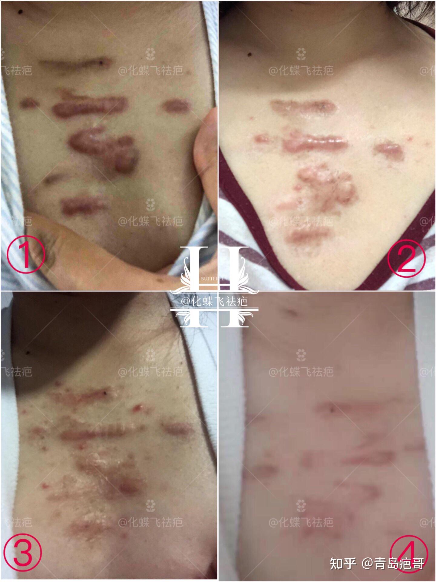 非要严重的疤痕疙瘩