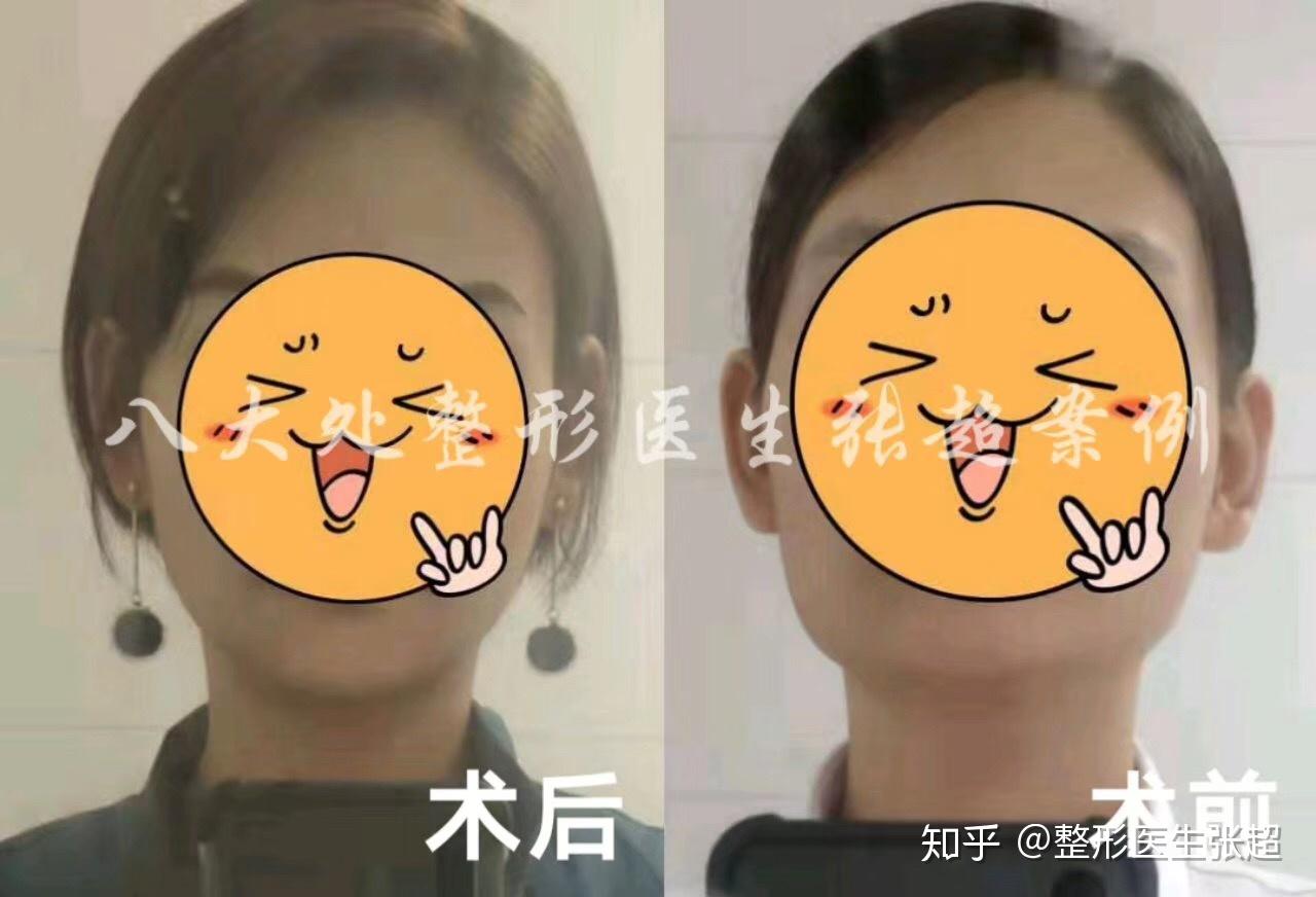 胶原蛋白填充_胶原蛋白填充有什么副作用_胶原蛋白的填充