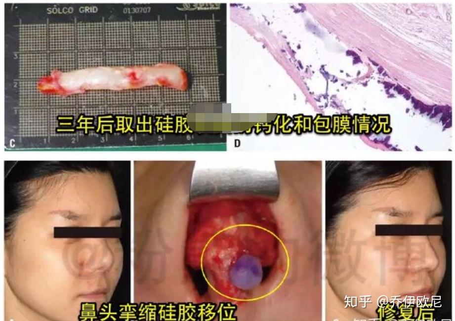 膨体隆鼻容易感染吗?会有后遗症吗?