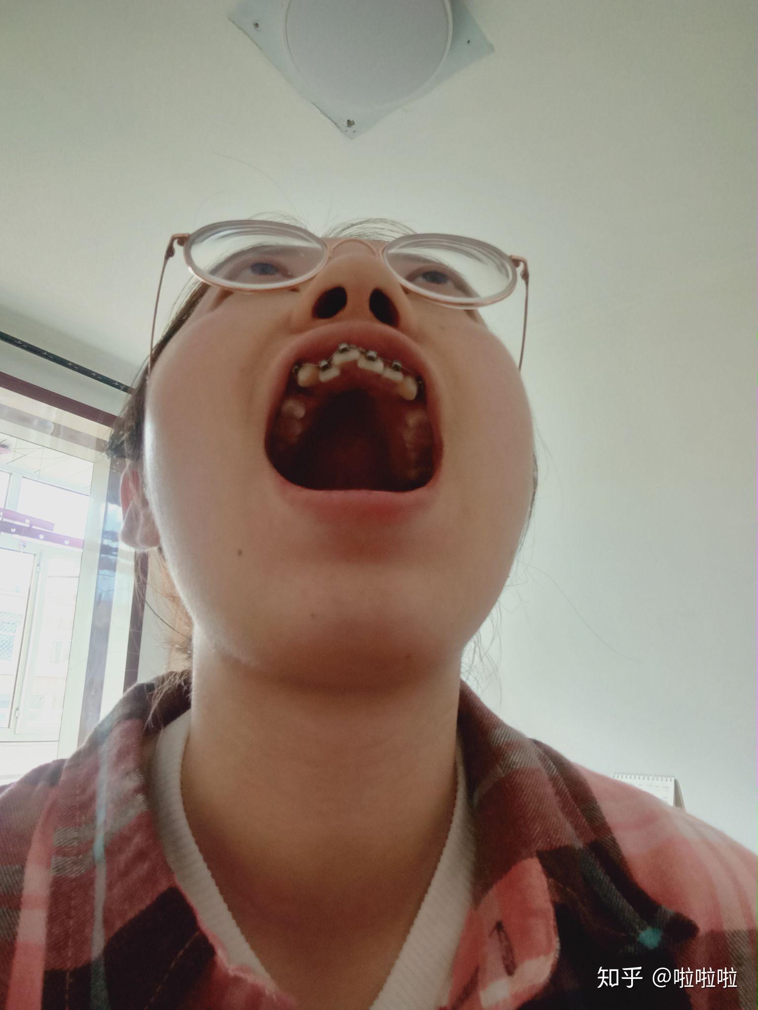 23岁带牙套 - 知乎