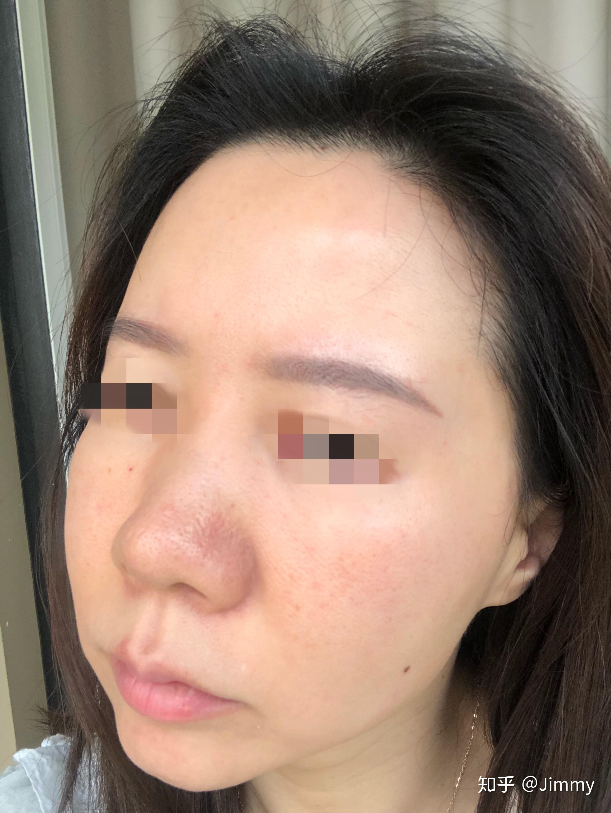 韩国露飞ruffy婴儿针