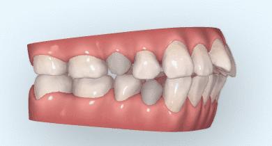益芽微笑公式=美观健康的牙齿 肌肉系统平衡 正确舌位 微笑线