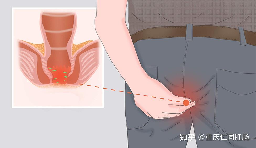 為什麼肛門的地方有一個小肉球突出重慶肛腸醫院哪家好