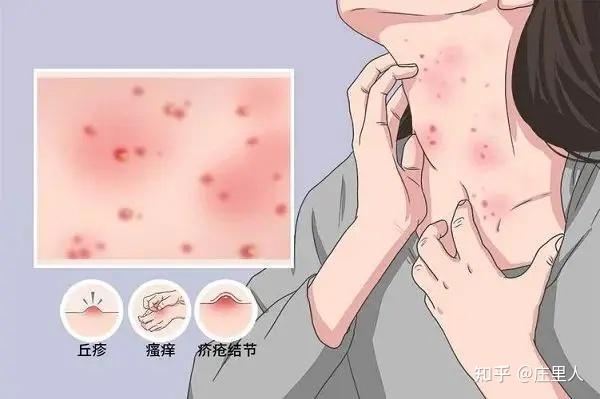 疥疮的几种传播方式? - 知乎