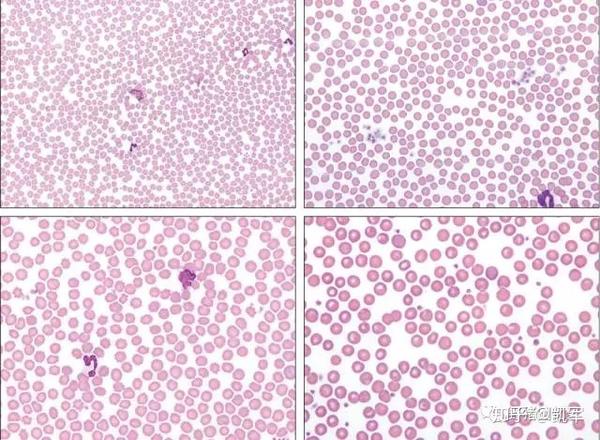 用40x的物镜可以对血涂片中的白细胞进行基本的判读,其数量是少,正常