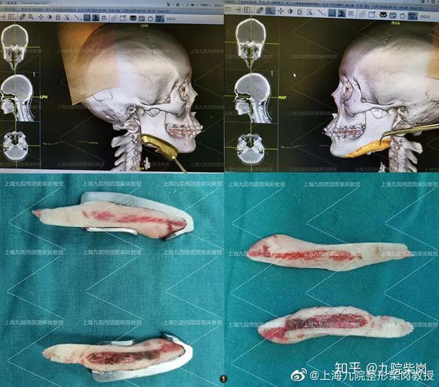 下頜角截骨 ,顴骨磨骨類手術都屬於三級手術目錄裡,能做這個手術的都