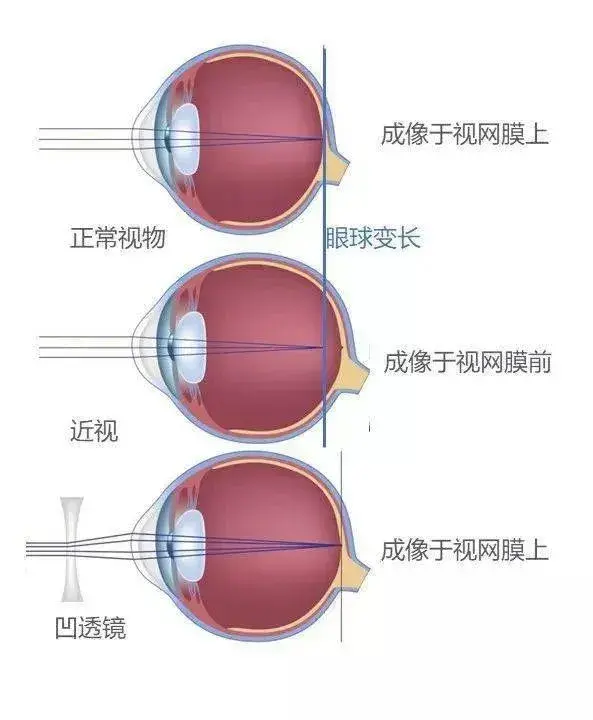 近视眼形成的原理图片